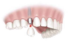 Clinica Dental ICa prótesis dental