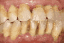 Dentista Ica - periodontitis
